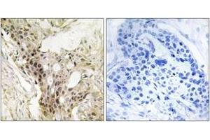 Immunohistochemistry analysis of paraffin-embedded human breast carcinoma tissue, using MED21 Antibody. (MED21 抗体  (AA 71-120))
