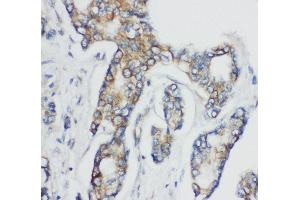 Anti-CD1d antibody, IHC(P) IHC(P): Human Mammary Cancer Tissue (CD1d 抗体  (N-Term))