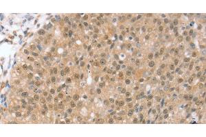 Immunohistochemistry of paraffin-embedded Human breast cancer using TRIM35 Polyclonal Antibody at dilution of 1:35 (TRIM35 抗体)