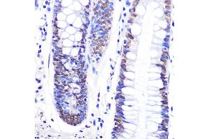 Immunohistochemistry of paraffin-embedded human colon using Snail Rabbit pAb (ABIN6134928, ABIN6148176, ABIN6148179 and ABIN6215911) at dilution of 1:100 (40x lens). (SNAIL 抗体  (C-Term))