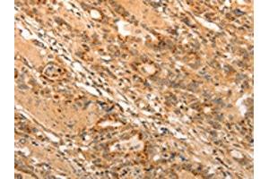 The image on the left is immunohistochemistry of paraffin-embedded Human gastic cancer tissue using ABIN7189699(ADRA1B Antibody) at dilution 1/20, on the right is treated with synthetic peptide. (ADRA1B 抗体)