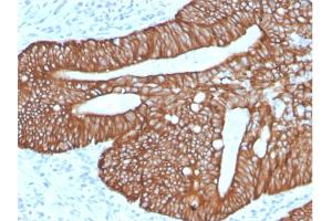 Formalin-fixed, paraffin-embedded human Colon Carcinoma stained with Cytokeratin 18Rabbit Recombinant Monoclonal Antibody (KRT18/2819R). (Recombinant Cytokeratin 18 抗体)
