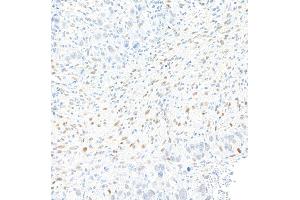 Immunohistochemistry (IHC) image for anti-Zinc Finger E-Box Binding Homeobox 1 (ZEB1) (AA 750-800) antibody (ABIN7455173) (Recombinant ZEB1 抗体  (AA 750-800))