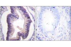 Immunohistochemistry analysis of paraffin-embedded human colon carcinoma tissue, using PFKFB2 (Ab-483) Antibody. (PFKFB2 抗体  (AA 451-500))