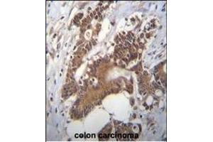 PCYT1A Antibody (N-term) (ABIN656103 and ABIN2845445) immunohistochemistry analysis in formalin fixed and paraffin embedded human colon carcinoma followed by peroxidase conjugation of the secondary antibody and DAB staining. (PCYT1A 抗体  (N-Term))
