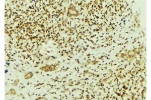 ABIN6269322 at 1/100 staining Human breast cancer tissue by IHC-P. (FAK 抗体  (Internal Region))
