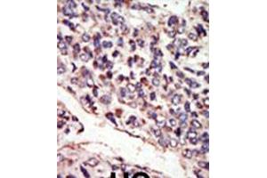 Formalin-fixed and paraffin-embedded human cancer tissue reacted with the primary antibody, which was peroxidase-conjugated to the secondary antibody, followed by DAB staining. (NTRK3 抗体  (N-Term))