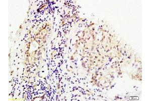 Formalin-fixed and human breast carcinoma tissue labeled with Anti-MMS19 Polyclonal Antibody, Unconjugated at 1:200 followed by conjugation to the secondary antibody and DAB staining (MMS19 抗体  (AA 851-950))