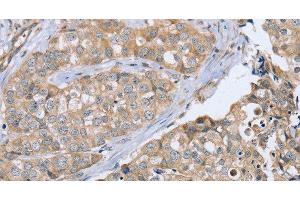 Immunohistochemistry of paraffin-embedded Human breast cancer using CYTH1 Polyclonal Antibody at dilution of 1:40 (Cytohesin 1 抗体)