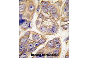 Formalin-fixed and paraffin-embedded human breast carcinoma tissue reacted with CDH13 polyclonal antibody  , which was peroxidase-conjugated to the secondary antibody, followed by DAB staining. (Cadherin 13 抗体  (C-Term))