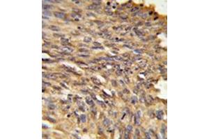 Immunohistochemistry in formalin-fixed and paraffin-embedded human lung carcinoma reacted with Vigilin / HDLBP Antibody (Center) followed which was peroxidase-conjugated to the secondary antibody, followed by DAB staining. (HDLBP 抗体  (Middle Region))