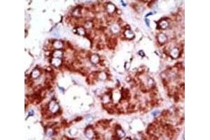 IHC analysis of FFPE human hepatocarcinoma tissue stained with the CPT1B antibody (CPT1B 抗体  (AA 606-637))