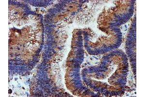 Immunohistochemical staining of paraffin-embedded Adenocarcinoma of Human colon tissue using anti-PDIA4 mouse monoclonal antibody. (PDIA4 抗体)