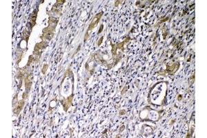 IHC testing of FFPE human rectal cancer tissue with VDBP antibody at 1ug/ml. (Vitamin D-Binding Protein 抗体)