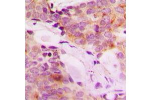 Immunohistochemical analysis of MRPS32 staining in human breast cancer formalin fixed paraffin embedded tissue section. (MRPL42 抗体  (Center))