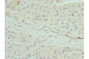 Immunohistochemistry of paraffin-embedded human liver cancer using ABIN7144441 at dilution of 1:100 (Apolipoprotein M 抗体  (AA 23-188))