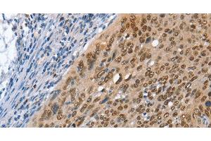 Immunohistochemistry of paraffin-embedded Human cervical cancer using MCM6 Polyclonal Antibody at dilution of 1:45 (MCM6 抗体)