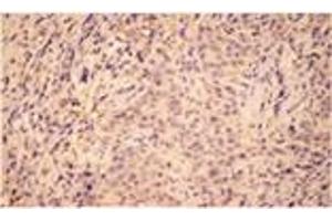 Immunohistochemistry analysis of human breast cancer tissue with HO-2 pAb. (HMOX2 抗体  (N-Term))