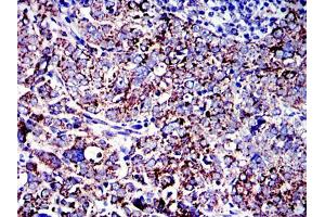 Immunohistochemical analysis of paraffin-embedded human cervical cancer tissues using AIF mouse mAb with DAB staining. (AIF 抗体)