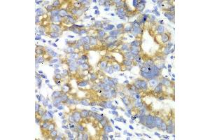 Immunohistochemistry of paraffin-embedded human gastric cancer using TFAM antibody at dilution of 1:100 (x40 lens). (TFAM 抗体)
