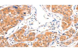 Immunohistochemistry of paraffin-embedded Human lung cancer using AMPD1 Polyclonal Antibody at dilution of 1:80 (AMPD1 抗体)