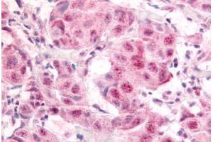 Human Breast Carcinoma (formalin-fixed, paraffin-embedded) stained with E2F1 antibody ABIN214450 at 10 ug/ml followed by biotinylated goat anti-rabbit IgG secondary antibody ABIN481713, alkaline phosphatase-streptavidin and chromogen. (E2F1 抗体  (pSer364))