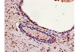 Immunohistochemistry of paraffin-embedded human prostate cancer using ABIN7154138 at dilution of 1:100 (GAPDH 抗体  (AA 3-335))