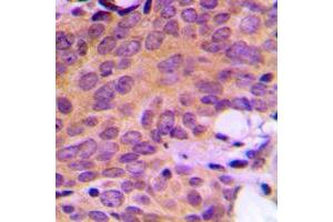 Immunohistochemical analysis of Ataxin 2 staining in human breast cancer formalin fixed paraffin embedded tissue section. (Ataxin 2 抗体  (Center))