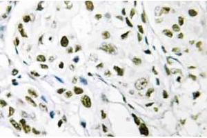 Immunohistochemistry (IHC) analyzes of Elongin A1 antibody in paraffin-embedded human breast carcinoma tissue. (TCEB3 抗体)