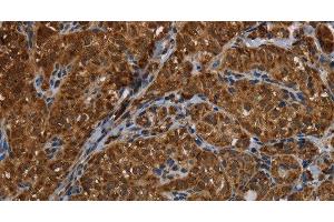 Immunohistochemistry of paraffin-embedded Human thyroid cancer using HSD17B13 Polyclonal Antibody at dilution of 1:30 (HSD17B13 抗体)