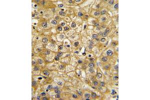 Formalin-fixed and paraffin-embedded human hepatocarcinoma with ADIPOR1 Antibody (C-term), which was peroxidase-conjugated to the secondary antibody, followed by DAB staining. (Adiponectin Receptor 1 抗体  (C-Term))