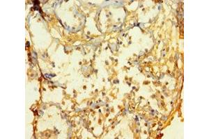 Immunohistochemistry of paraffin-embedded human breast cancer using ABIN7165112 at dilution of 1:100 (ATOH1 抗体  (AA 1-354))