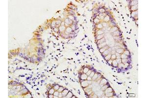 Formalin-fixed and paraffin embedded human colon carcinoma labeled with Anti-HMGA1/HMG-I/HMG-Y Polyclonal Antibody, Unconjugated  at 1:200 followed by conjugation to the secondary antibody and DAB staining. (HMGA1 抗体  (AA 51-107))