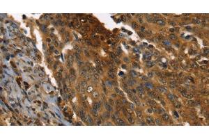 Immunohistochemistry of paraffin-embedded Human cervical cancer using PPIA Polyclonal Antibody at dilution of 1:35 (PPIA 抗体)