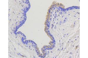 Immunohistochemistry of paraffin-embedded human mammary cancer using ARRB1 antibody (ABIN5996907) at dilution of 1/100 (40x lens). (beta Arrestin 1 抗体)