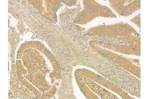 ABIN6265876 and ABIN6276800 at 1/100 staining human colon carcinoma by IHC-P. (UGT1A9 抗体  (C-Term))