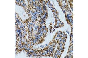 Immunohistochemistry of paraffin-embedded human gastric cancer using MRPL28 antibody. (MRPL28 抗体  (AA 1-256))