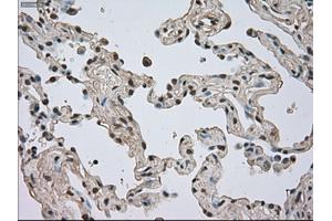 Immunohistochemical staining of paraffin-embedded Adenocarcinoma of breast tissue using anti-NTRK3 mouse monoclonal antibody. (NTRK3 抗体)