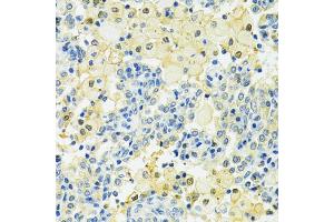 Immunohistochemistry of paraffin-embedded human lung cancer using SLC25A1 antibody (ABIN4905187) at dilution of 1:100 (40x lens). (Slc25a1 抗体)