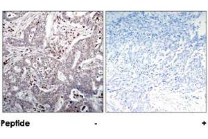 Immunohistochemical analysis of paraffin-embedded human breast carcinoma tissue using NFKBIB polyclonal antibody . (NFKBIB 抗体)