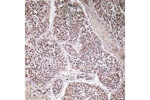 Immunohistochemical analysis of ATP5C1 staining in human liver cancer formalin fixed paraffin embedded tissue section. (ATP5C1 抗体)