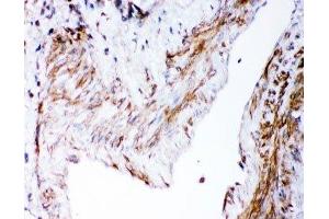 IHC-P: DHFR antibody testing of human lung cancer tissue (Dihydrofolate Reductase 抗体  (AA 2-187))