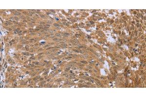 Immunohistochemistry of paraffin-embedded Human cervical cancer using FHL2 Polyclonal Antibody at dilution of 1:40 (FHL2 抗体)