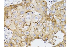 Immunohistochemistry of paraffin-embedded human breast cancer using PDE4D antibody (ABIN3022336, ABIN3022337, ABIN3022338 and ABIN6218749) at dilution of 1:100 (40x lens). (PDE4D 抗体  (AA 249-518))
