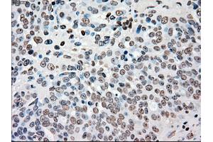 Immunohistochemical staining of paraffin-embedded colon tissue using anti-CHEK2mouse monoclonal antibody. (CHEK2 抗体)