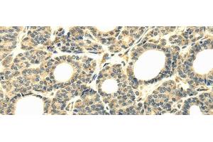 Immunohistochemistry of paraffin-embedded Human thyroid cancer tissue using WDR45B Polyclonal Antibody at dilution 1:40 (WD Repeat Domain 45B (WDR45B) 抗体)