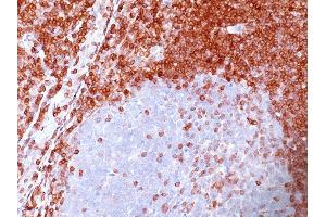 Formalin-fixed, paraffin-embedded human Non-Hodgkin's Lymphoma stained with Bcl-2 Mouse Monoclonal Antibody (SPM117). (Bcl-2 抗体  (AA 41-54))