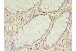 Immunohistochemistry of paraffin-embedded human colon cancer using ABIN7159891 at dilution of 1:100 (TIMM1 (AA 1-90) 抗体)