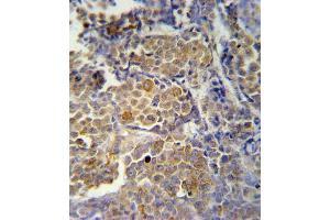 KIR2DS2 Antibody (Center) (ABIN651951 and ABIN2840473) immunohistochemistry analysis in formalin fixed and paraffin embedded human skin carcinoma followed by peroxidase conjugation of the secondary antibody and DAB staining. (KIR2DS2 抗体  (AA 39-65))