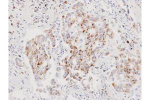 IHC-P Image Immunohistochemical analysis of paraffin-embedded human lung cancer, using AIF, antibody at 1:100 dilution. (AIF 抗体  (N-Term))